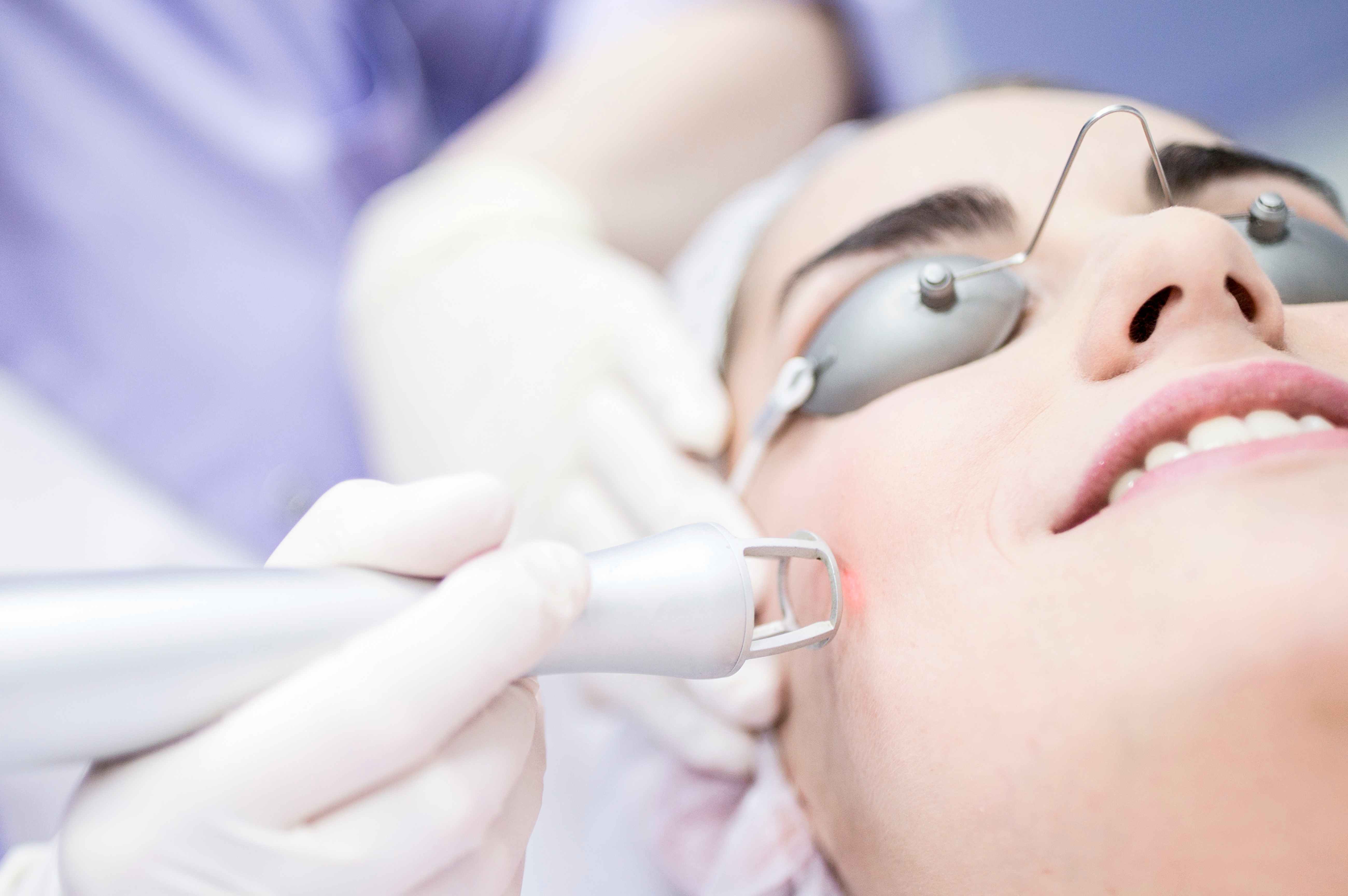 What Is a Laser Lift? Complete Guide to How It Works and Its Benefits