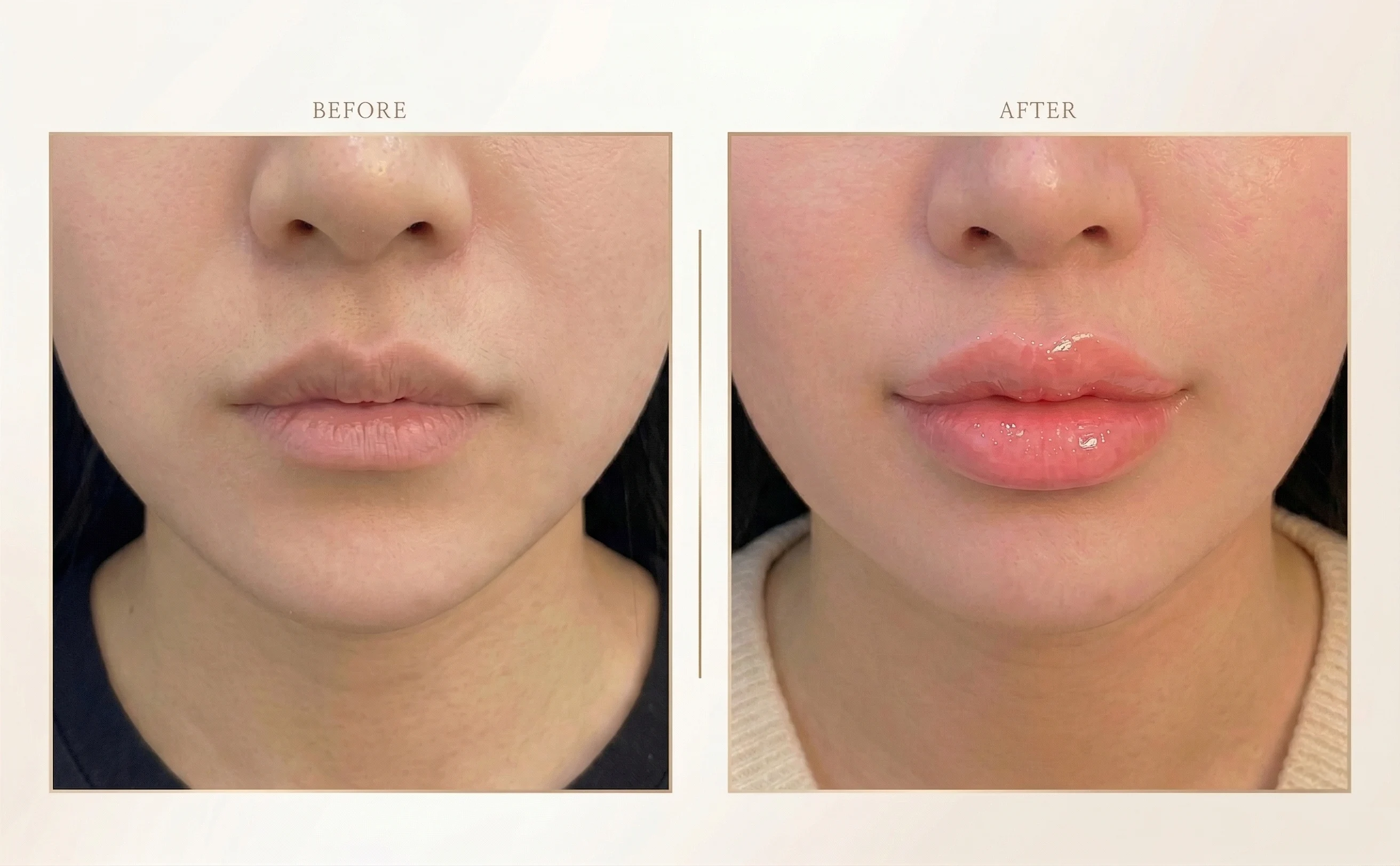 입술필러 맛집, 병원 고르는 기준과 상세 추천 리스트