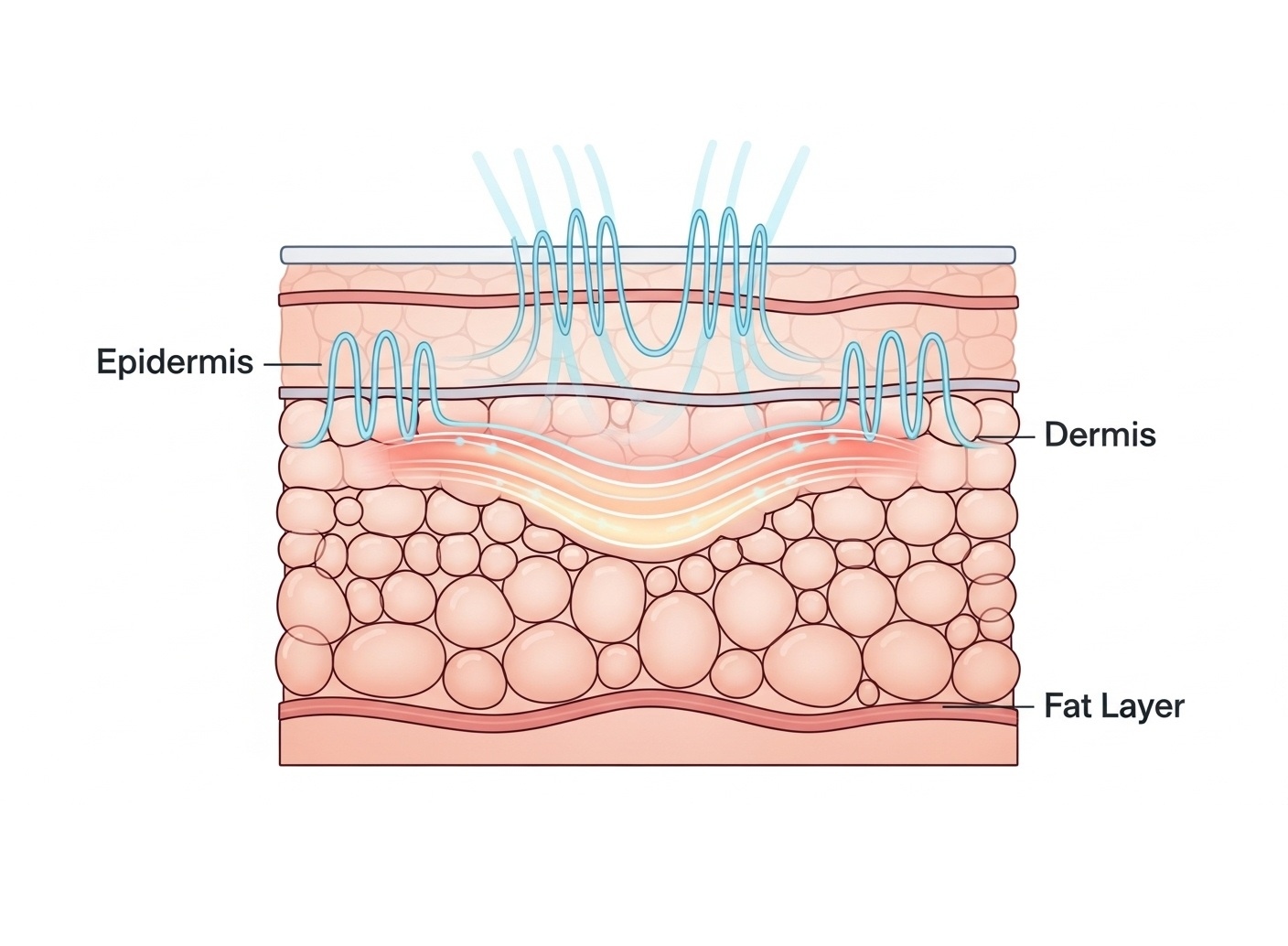 고주파레이저 궁금증 총정리 : 탄력, 모공, 주름 개선의 모든 것