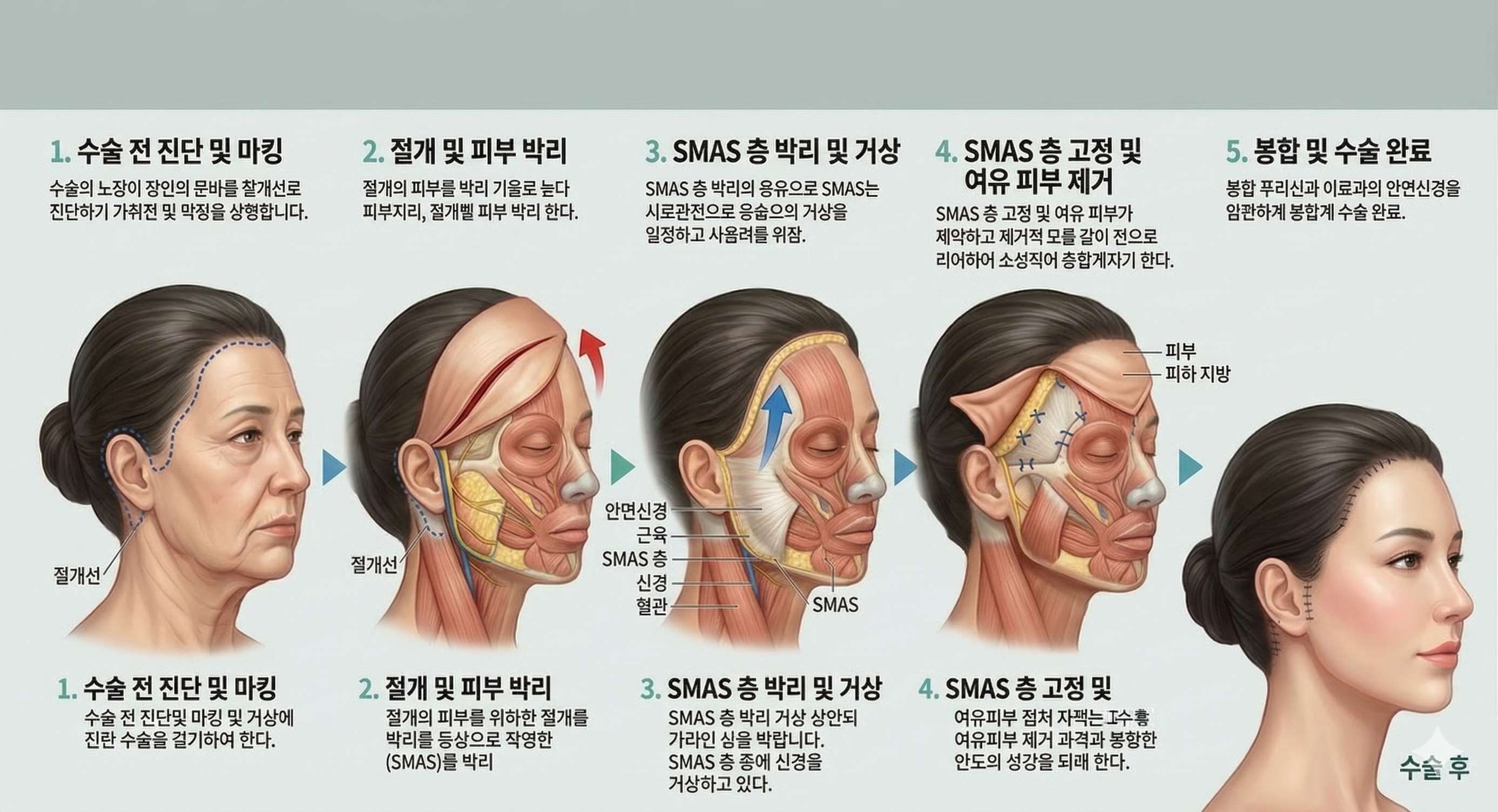 안면거상수술방법 완전정복: 단계별, 유형별 안내