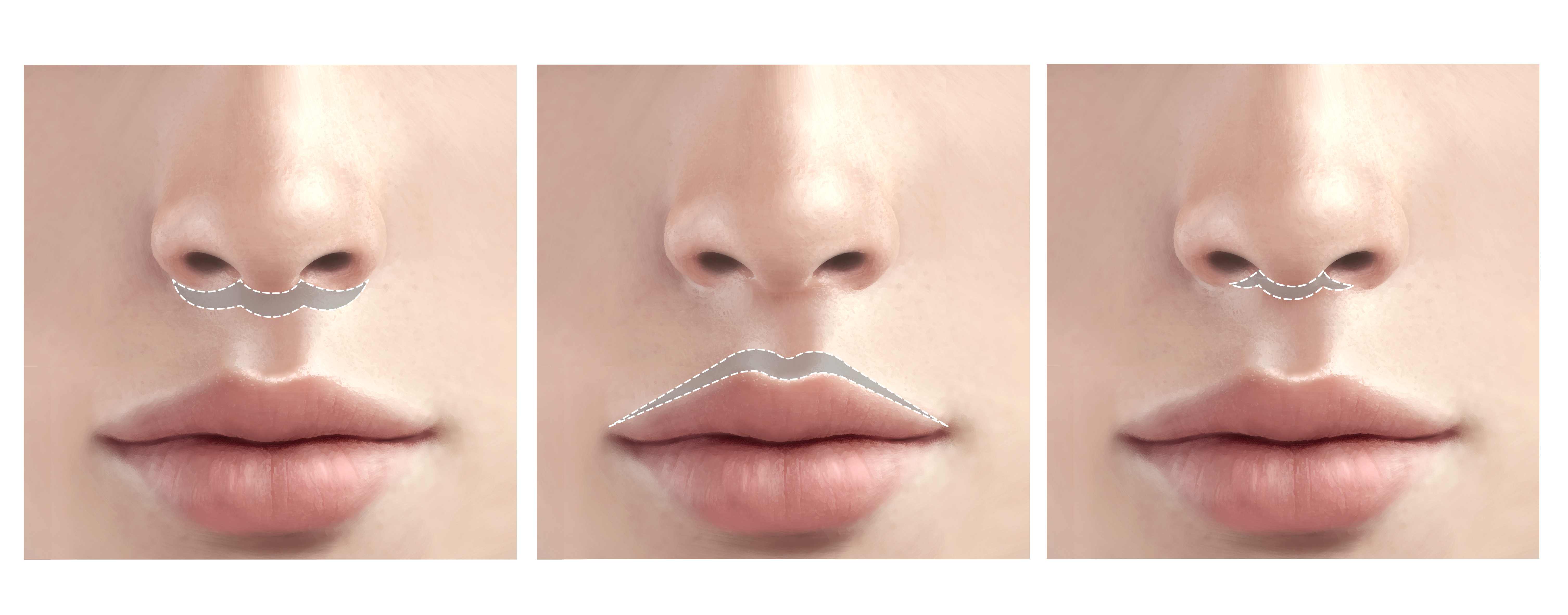 인중축소시술, 내게 맞는 방법은? 수술·비수술 완전 가이드