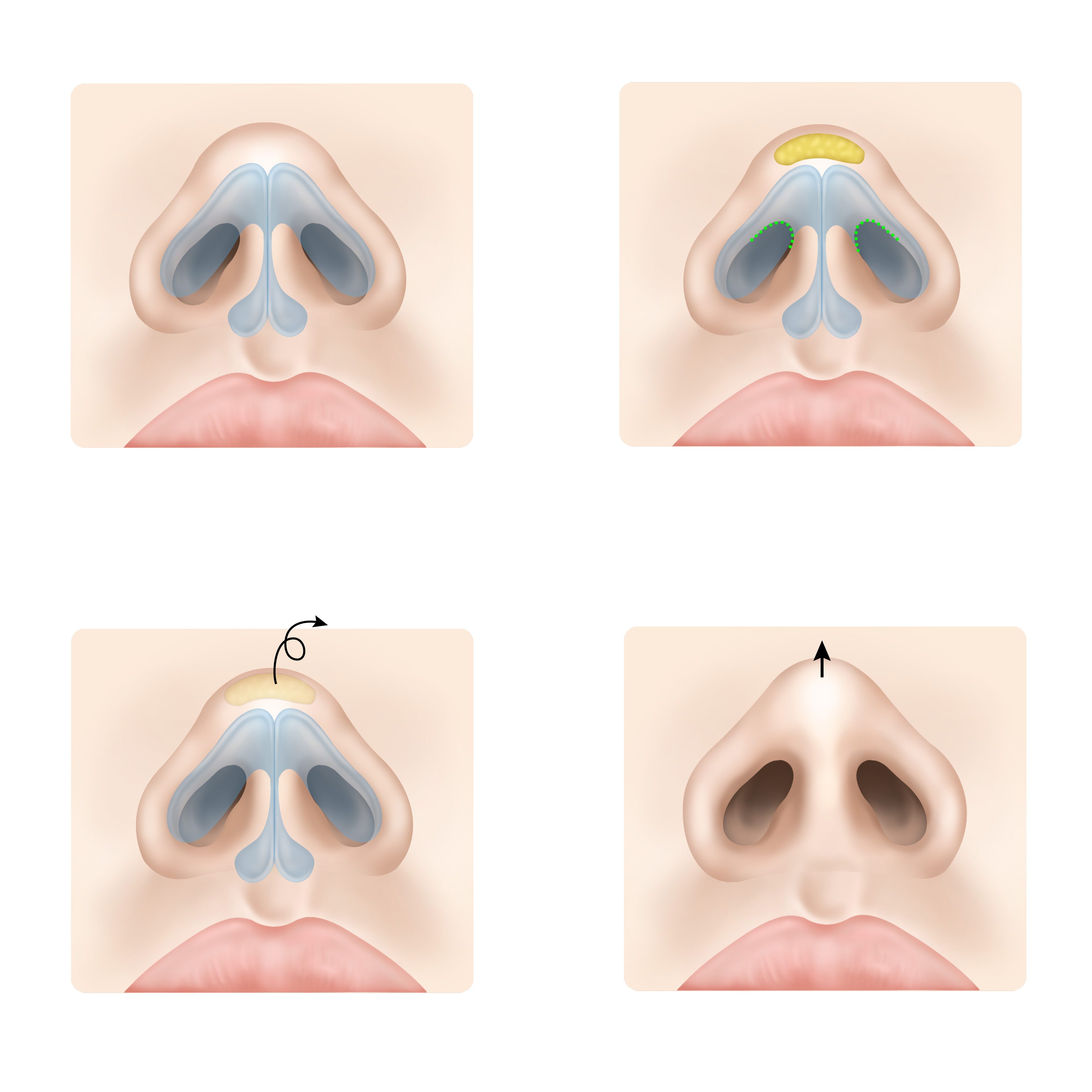 콧구멍필러 vs 콧볼축소수술: 내게 맞는 선택법