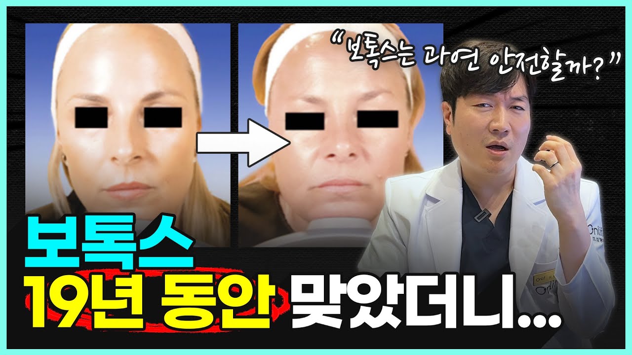 보톡스 오래 맞으면 괜찮을까? 13년 연구로 알아본 효과와 안전한 시술법