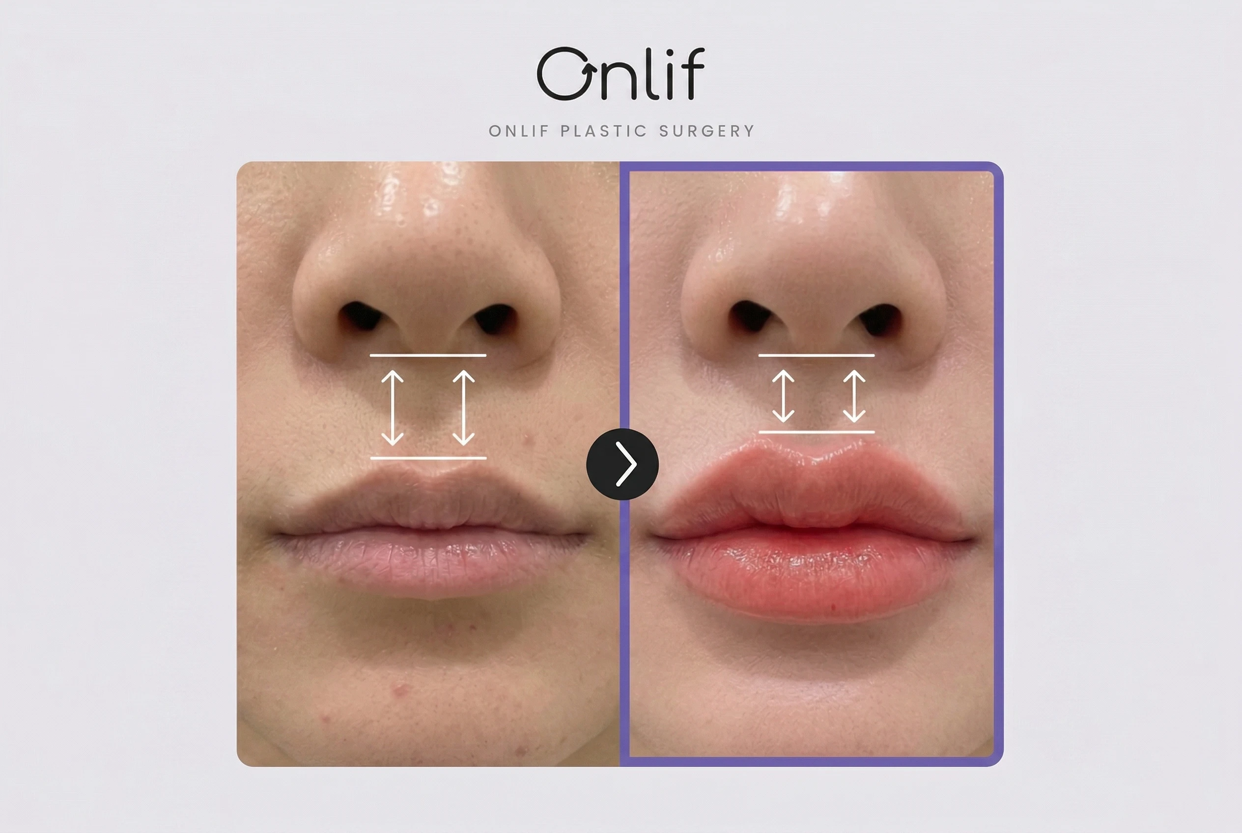 인중축소보톡스, 수술 없이도 효과 있을까?