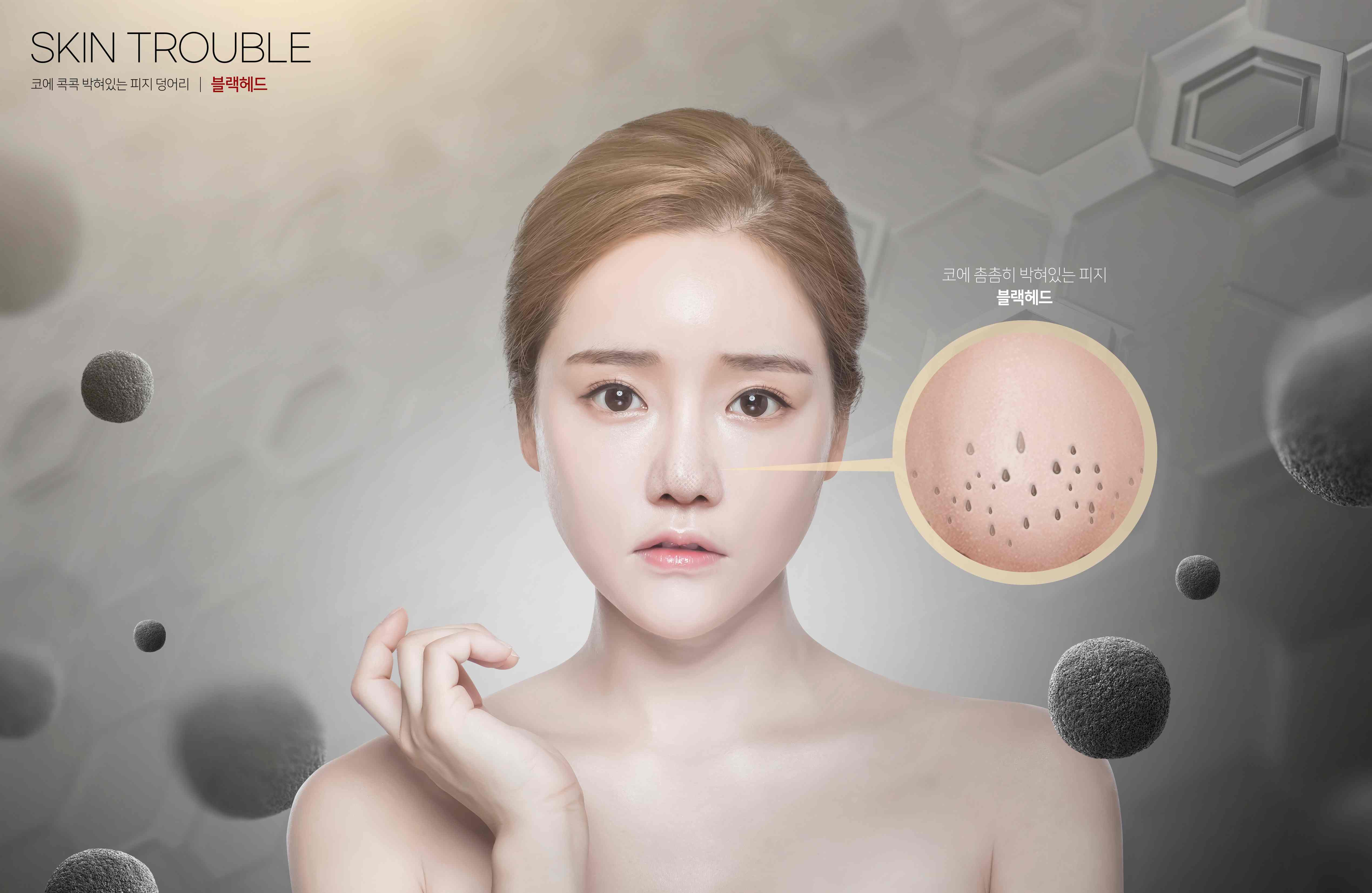 블랙헤드 제거 시술 완벽 가이드: 종류, 효과, 주의사항 총정리