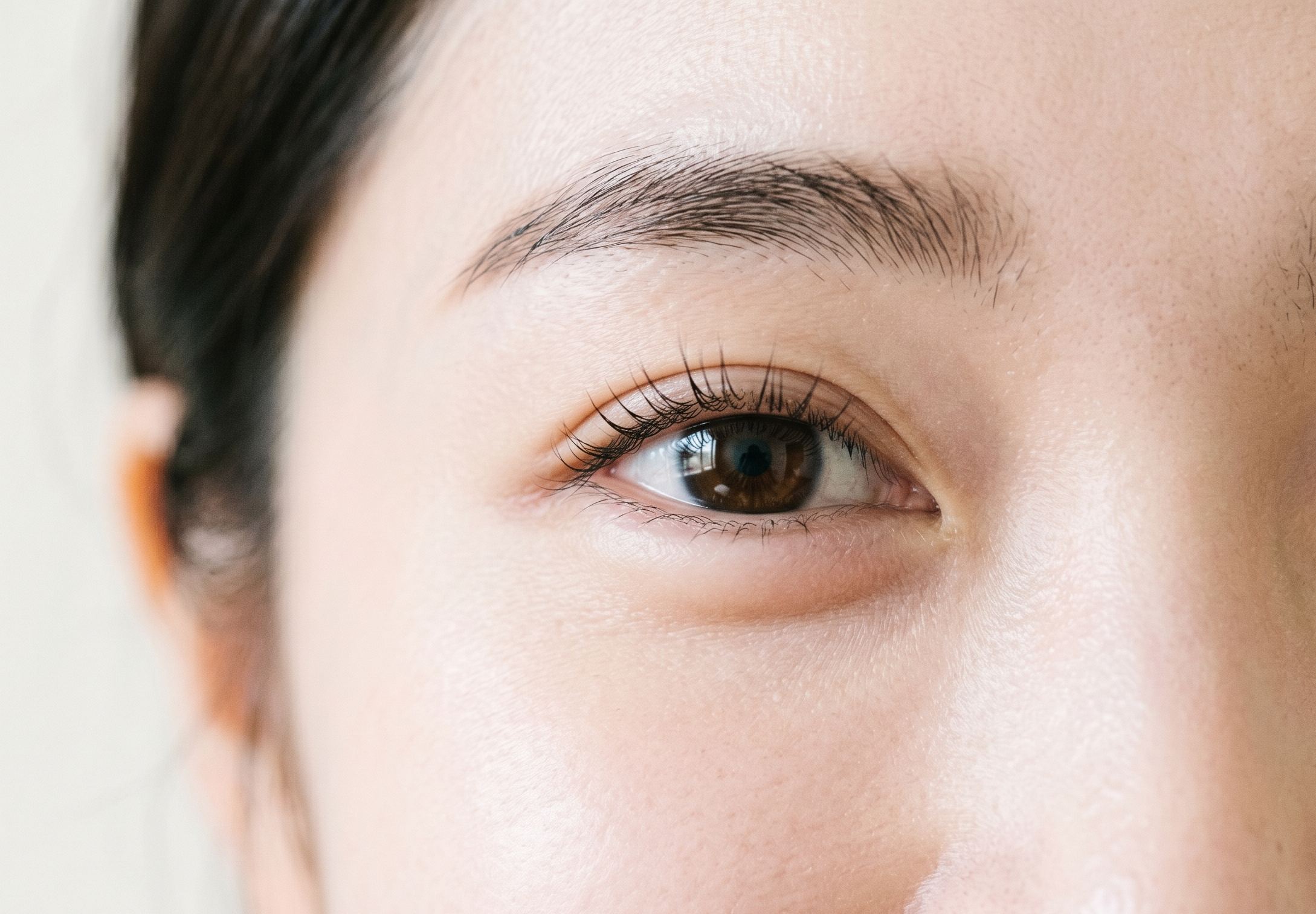 애교살 필러 멍·붓기, 얼마나 가고 어떻게 관리할까?